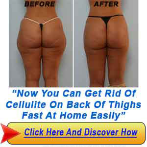 Get Rid Of Cellulite on Back of Thighs