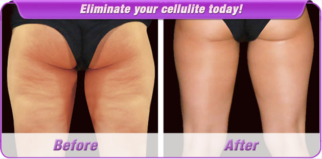 Cellulite Cream