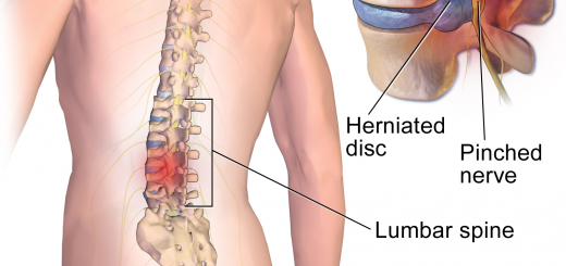 Sciatica Treatment