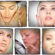 How to Get Rid Of Acne & Acne Scars FAST
