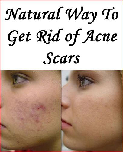 How to Get Rid Of Acne