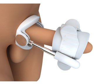 Penile Extender