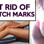 How to Get Rid Of Stretch Marks Fast & Naturally?