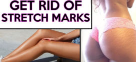How to Get Rid Of Stretch Marks Fast & Naturally?