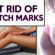 How to Get Rid Of Stretch Marks Fast & Naturally?