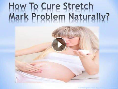 How to Get Rid Of Stretch Marks for Men