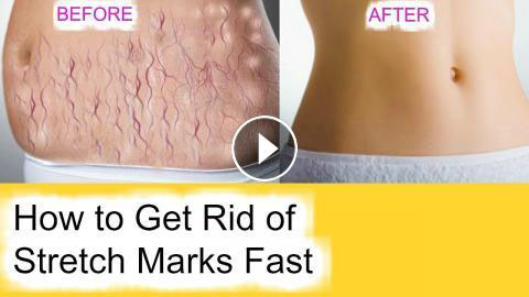 How to Get Rid Of Stretch Marks in a Week