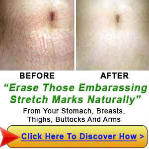 How to Get Rid Of Stretch Marks on Thighs