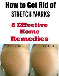 How to Get Rid Of Stretch Marks