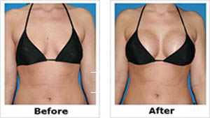 Breast Augmentation