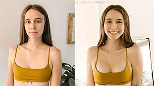 Breasts Augmentation Before And After